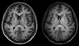 Two MRI brain scans next to each other