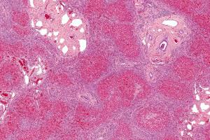 fibrosis cells