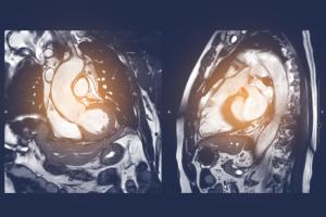 MRI images of a human heart